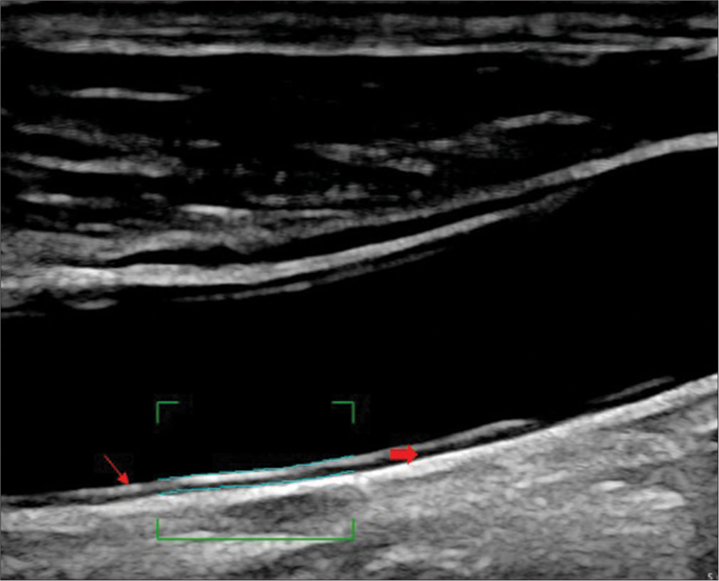 Carotid plaque volume measurement in ischemic stroke: A pilot study