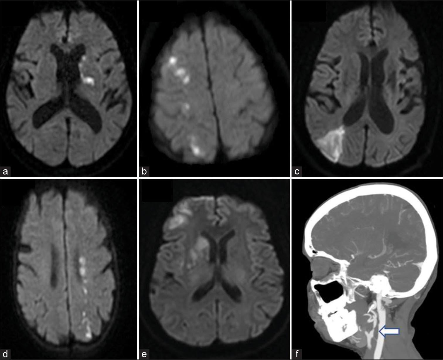 Clinical characteristics and imaging patterns of cerebral infarction with outcomes of carotid artery stenting in symptomatic carotid stenosis: An eight-year journey