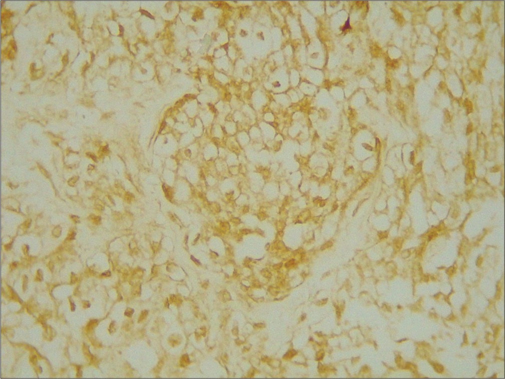 Differences in merlin and p53 expression as a predisposing factor in orbital meningioma