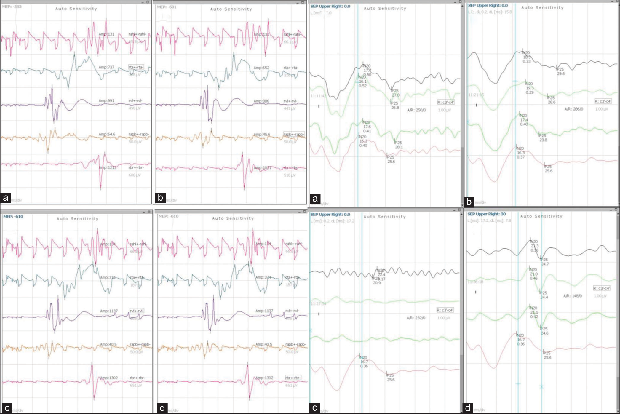 Navigating a grey zone: Neuromonitoring in the management of temporary internal carotid artery occlusion techniques - A case series and literature review