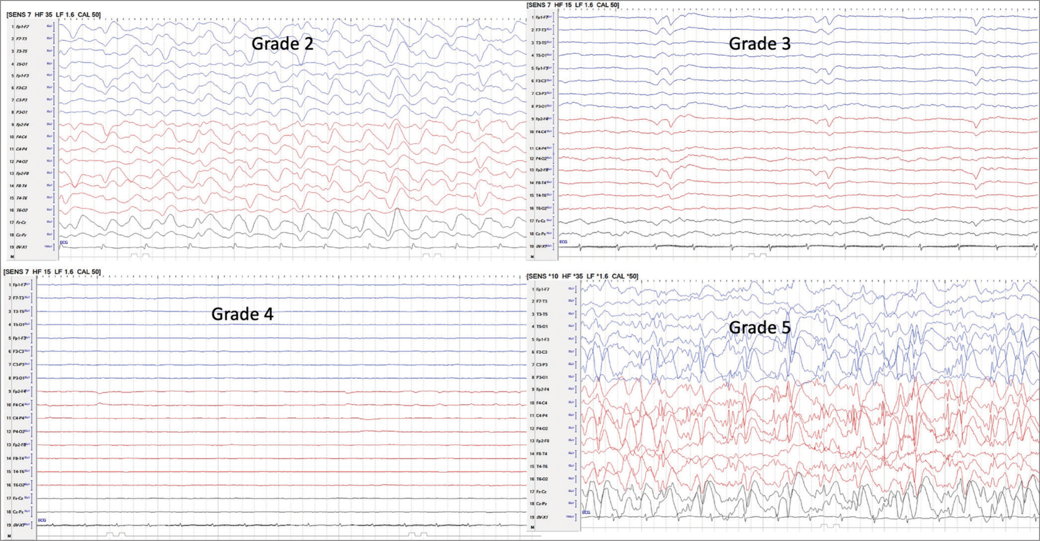 Electroencephalograph and optic nerve sheath diameter: Comparative usefulness in prediction of hepatic encephalopathy outcome in children