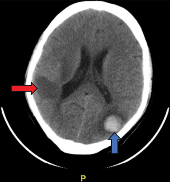 Unveiling the mystery: Infective endocarditis as an etiological cause of recurrent intracranial hemorrhage