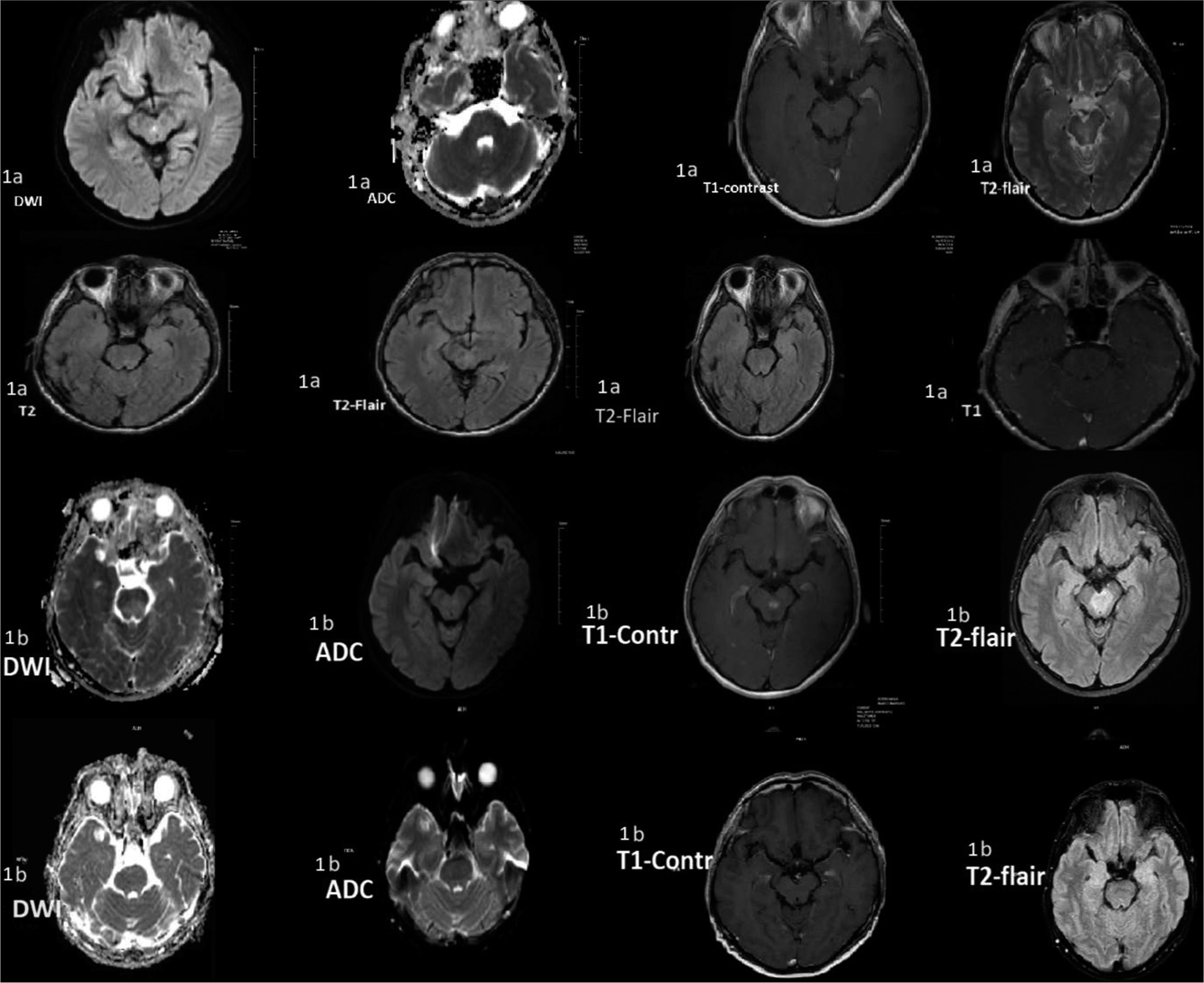 Recurrent demyelination attacks after BNT162b2 vaccination: Two case reports and literature review