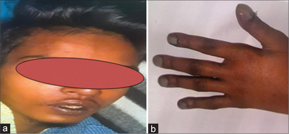 Pseudosubarachnoid hemorrhage sign in a patient with tetralogy of Fallot