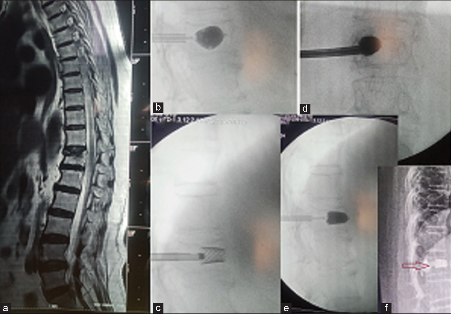 Percutaneous unilateral vertebro-stentoplasty for painful osteoporotic compression fracture of lumbar vertebra