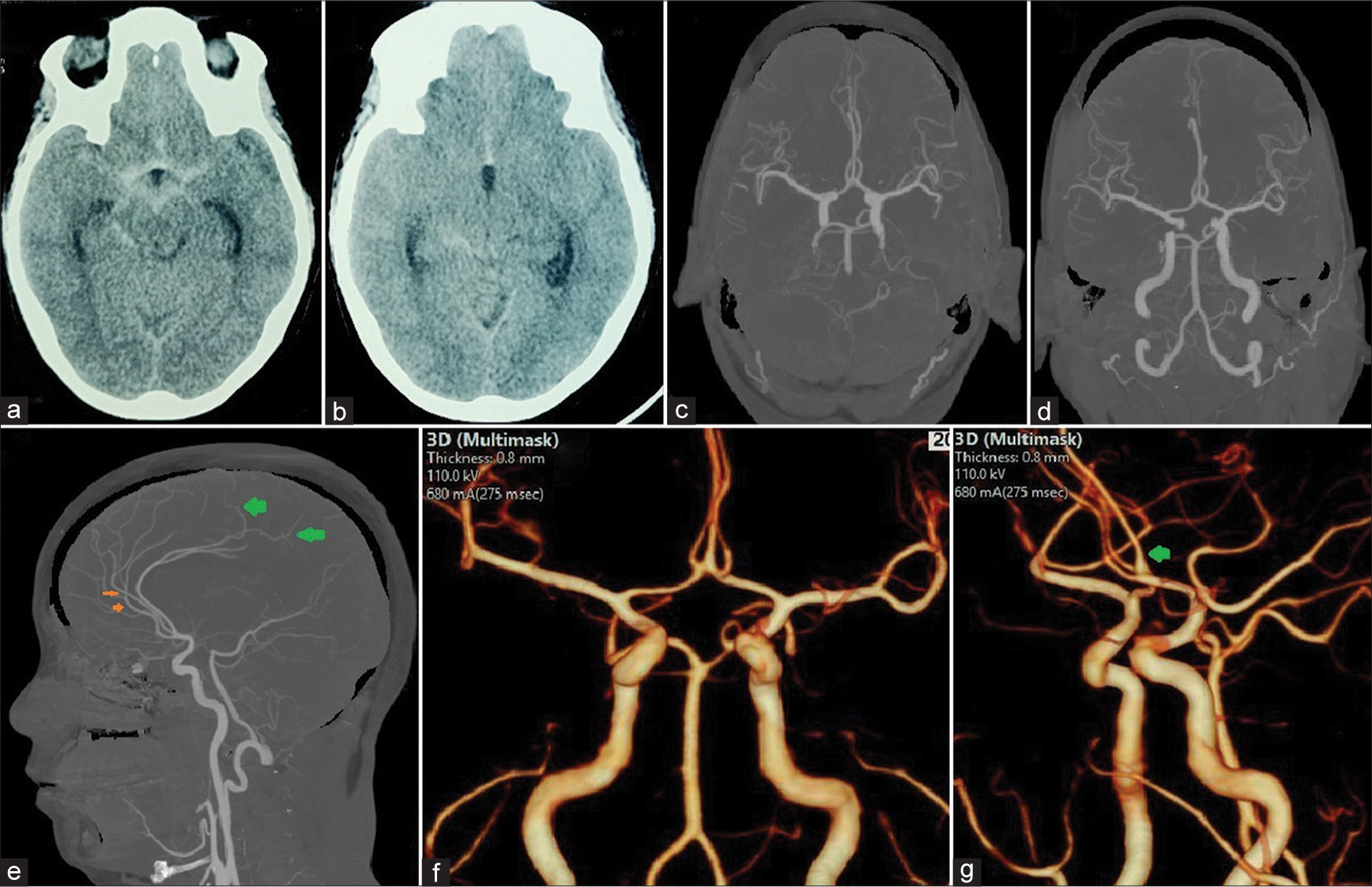 Angiographic “omega (ω) sign” in the median artery of the corpus callosum