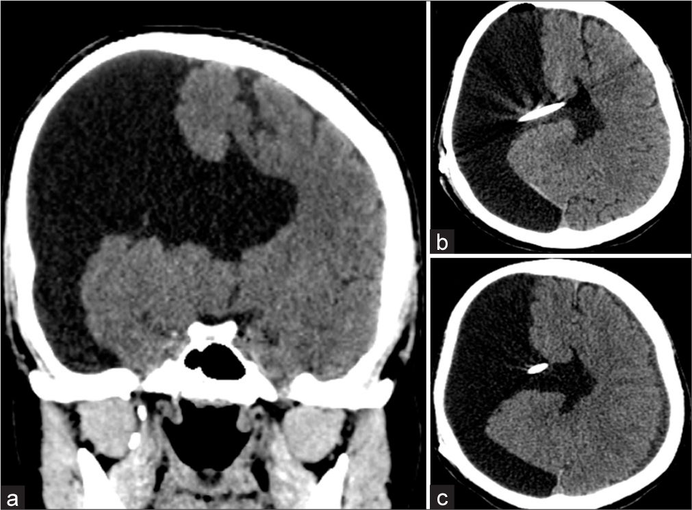 Report of ventriculoperitoneal shunt for lately detected open-lip schizencephaly