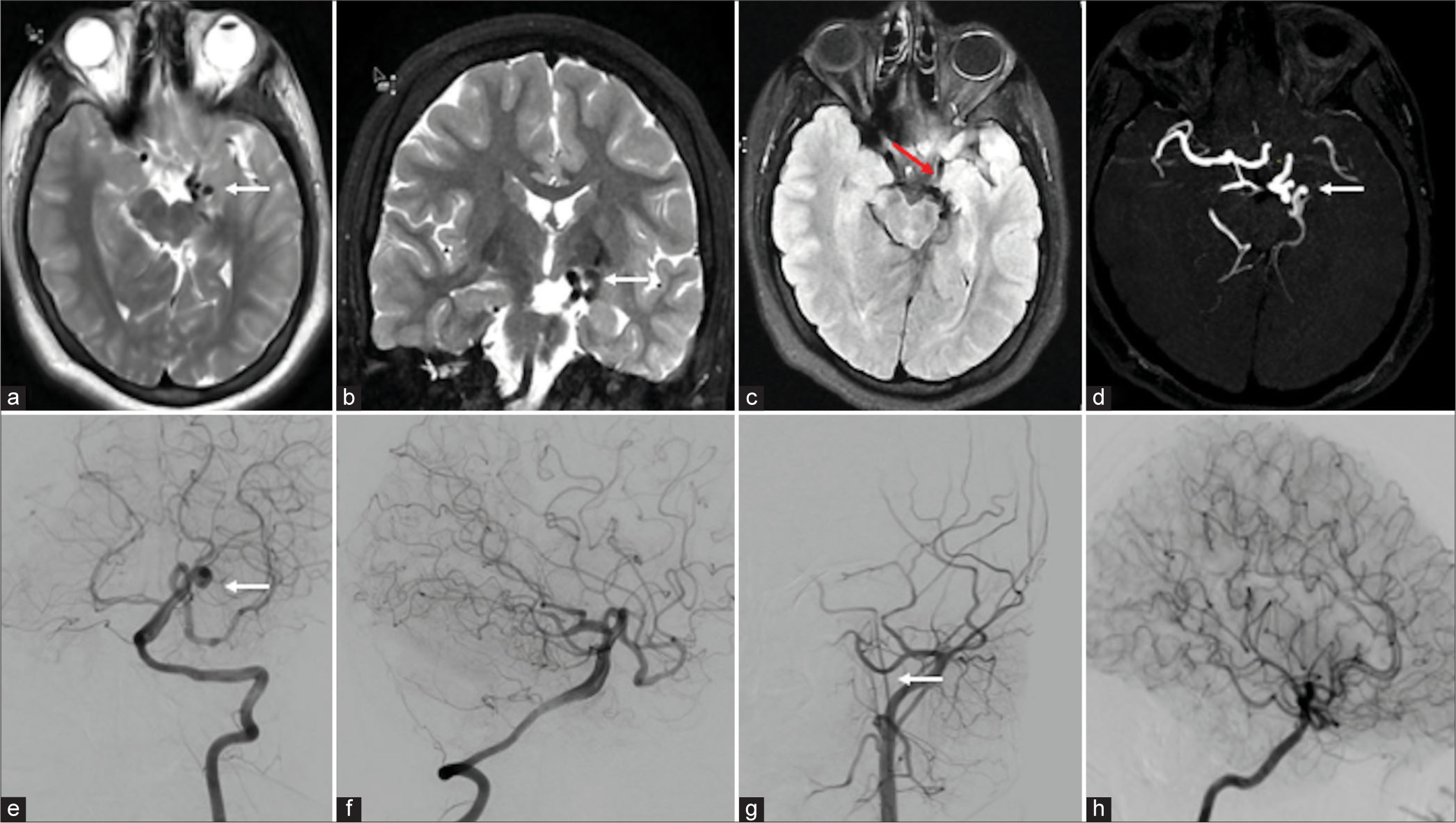 Pure arterial malformation: Reports of two rare cases