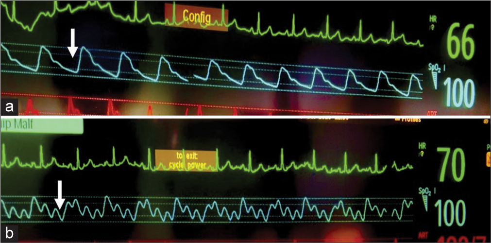 Plethysmography motion artifact can be an indicator of peripheral stimulus delivery during intraoperative somatosensory evoked potential recording