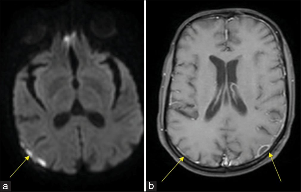 Neuromelioidosis: A farmer’s bane