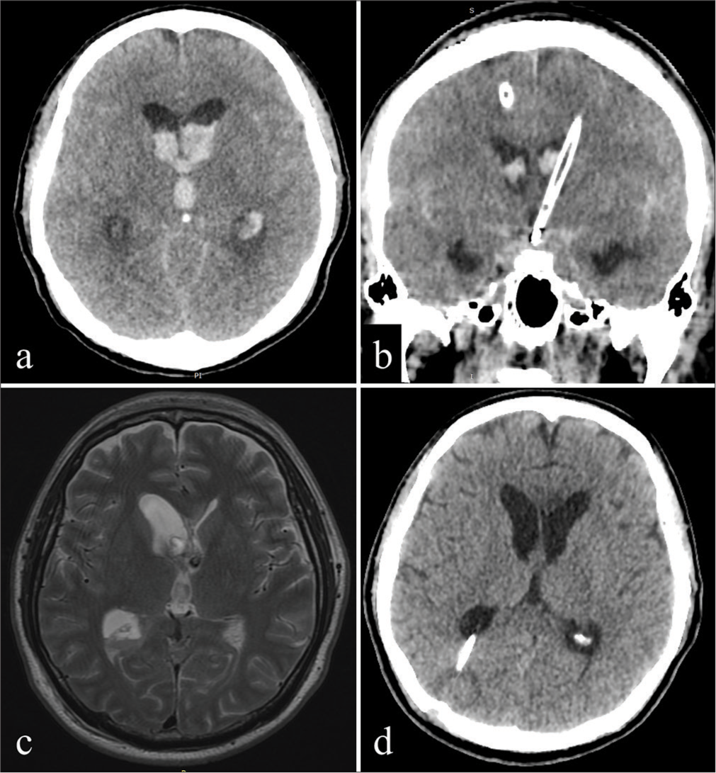 Unilateral hydrocephalus due to membranous occlusion of the foramen of Monro following extraventricular drainage and ventriculoperitoneal shunt for hydrocephalus after subarachnoid hemorrhage