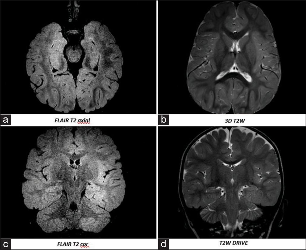 Developmental delay, seizures, and behavioral disorder caused by new SETD1B mutation: A case report