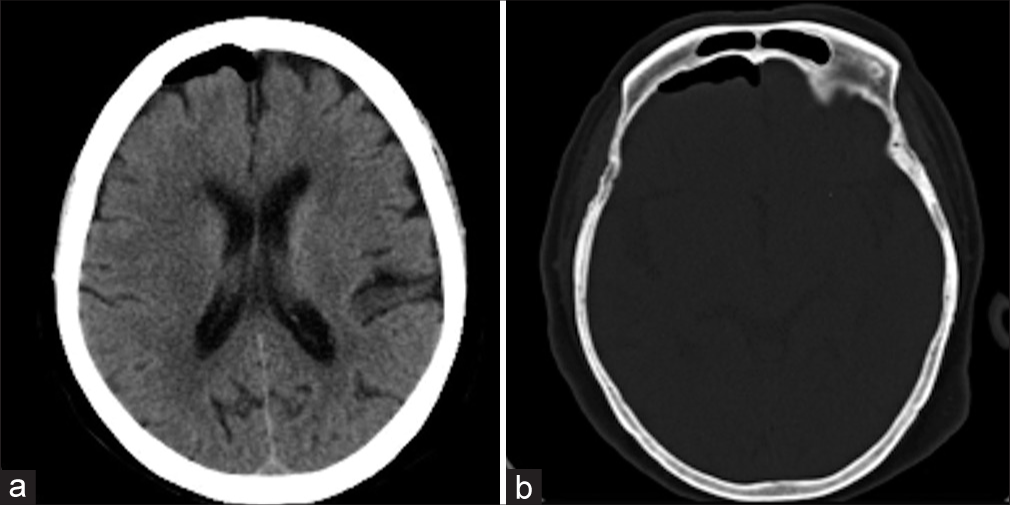 Nitrum komitake: An interesting case of thunderclap headache