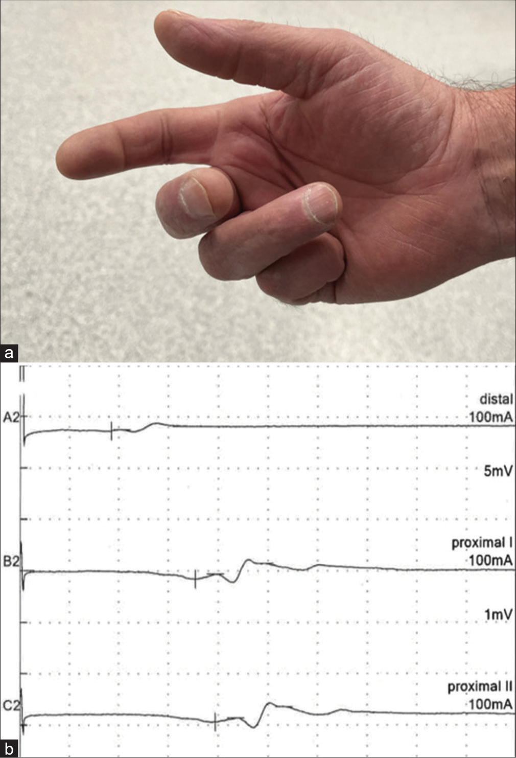 Multilocular peripheral neuropathy with delayed symptom progression and neuropathic pain after lightning strike