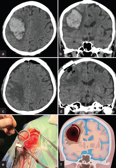 Is minimally invasive evacuation a future option in the management of spontaneous supratentorial intracerebral hemorrhage?