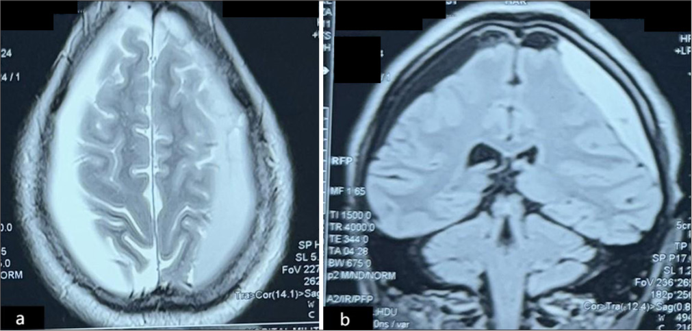 Subacute left hemispheric subdural hematoma associated with symptomatic contralateral hygroma