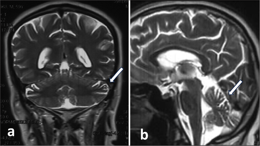 Anti-SOX1 antibody-associated paraneoplastic cerebellar degeneration without detectable tumor