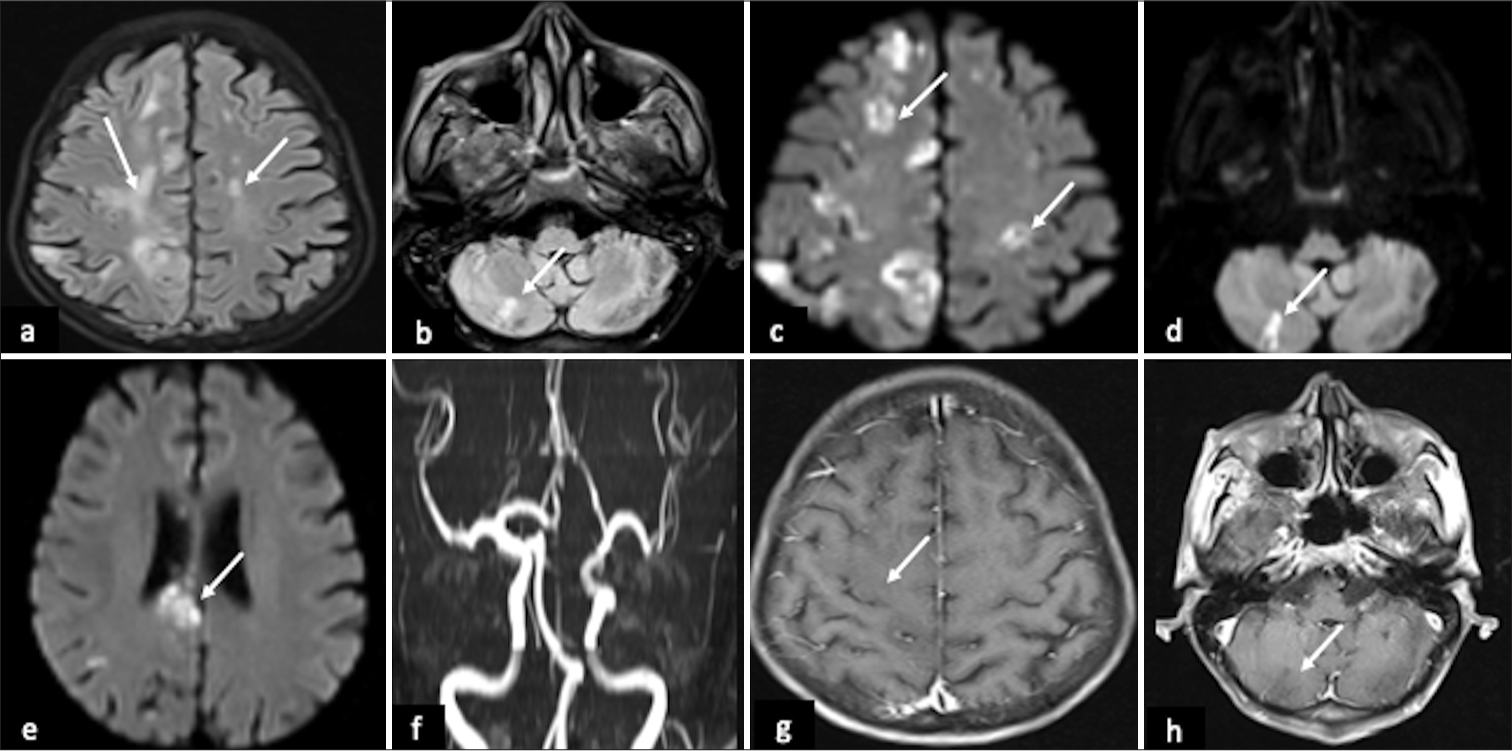 Three-territory infarct in Trousseau syndrome: A case series and review of literature