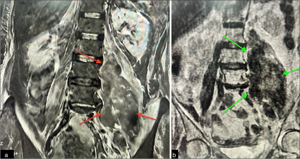An uncommon cause for acute limb weakness: Iliopsoas hematoma