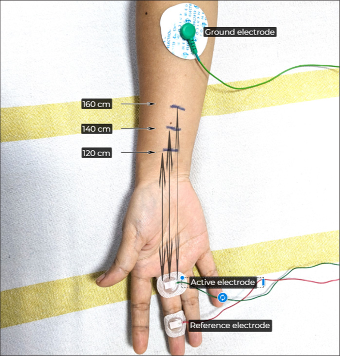 Fixed distance based determination of normative range of median nerve electro-diagnostic parameters