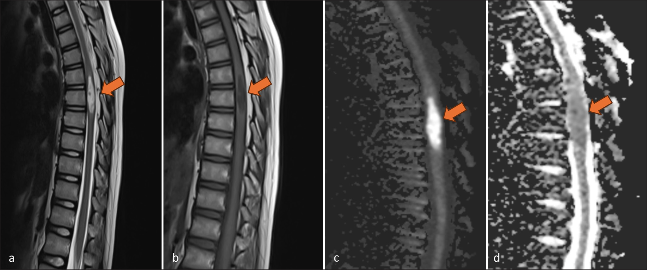 Congenital spinal intramedullary epidermoid cyst