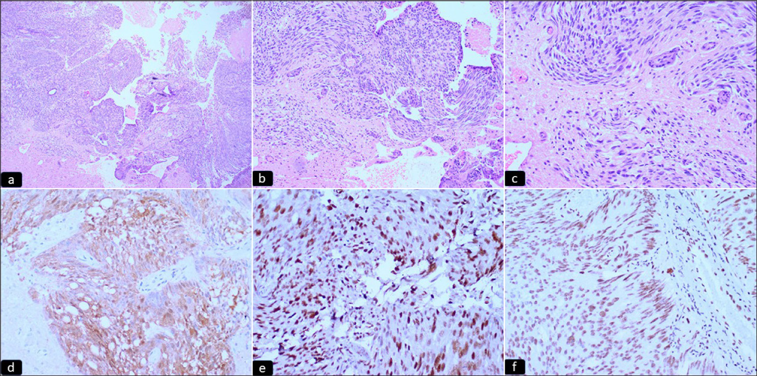 Intracranial collision tumor: A rare case report