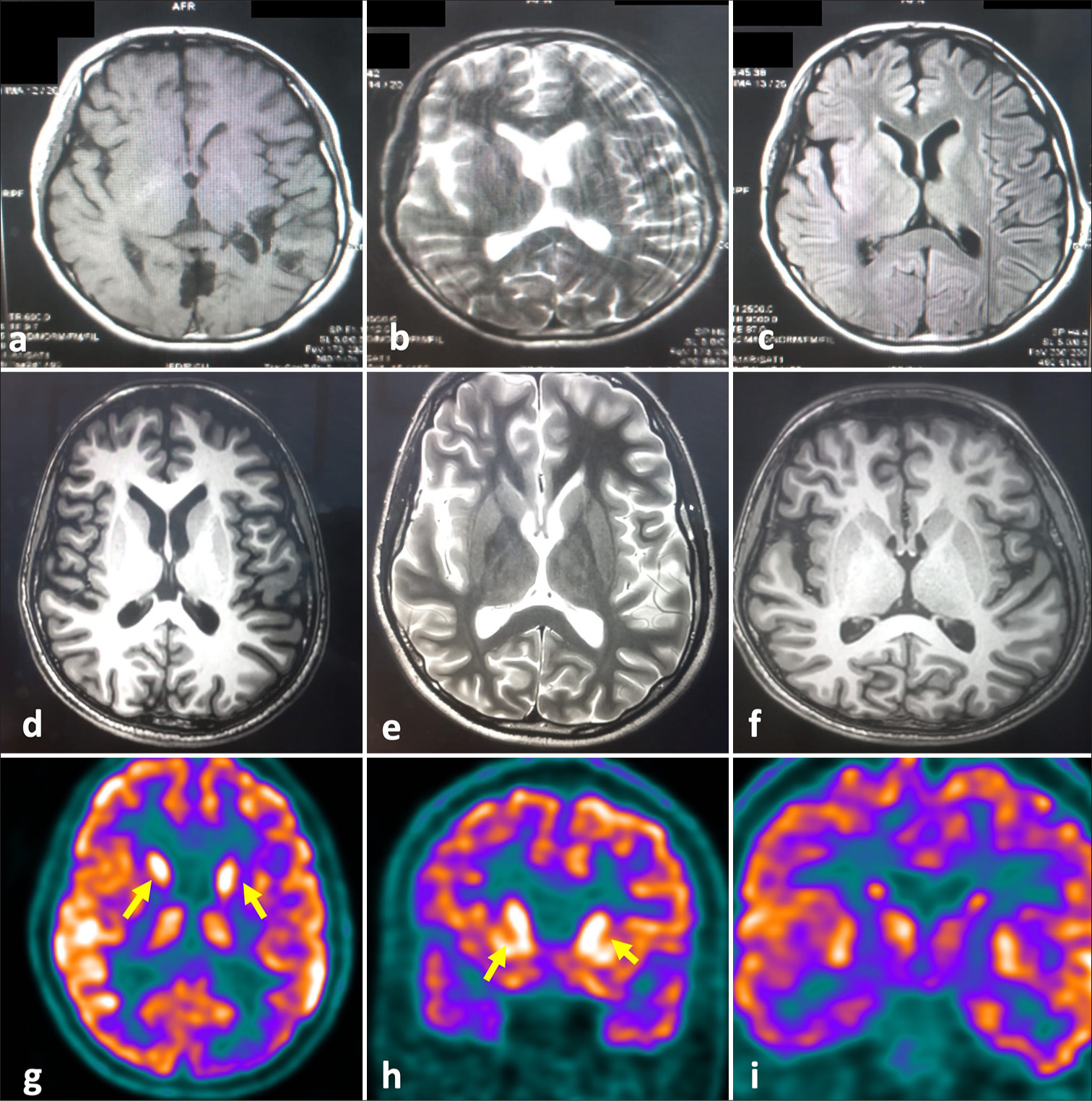 Dengue-associated autoimmune encephalitis presenting as a dystonic storm in a young male: A rare case report