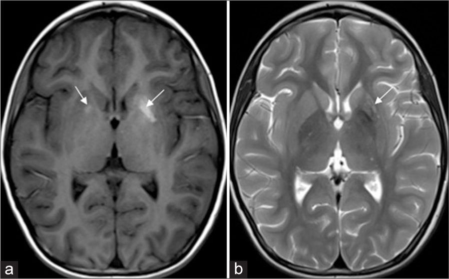 Diabetic striatopathy in a child with type 1 diabetes mellitus