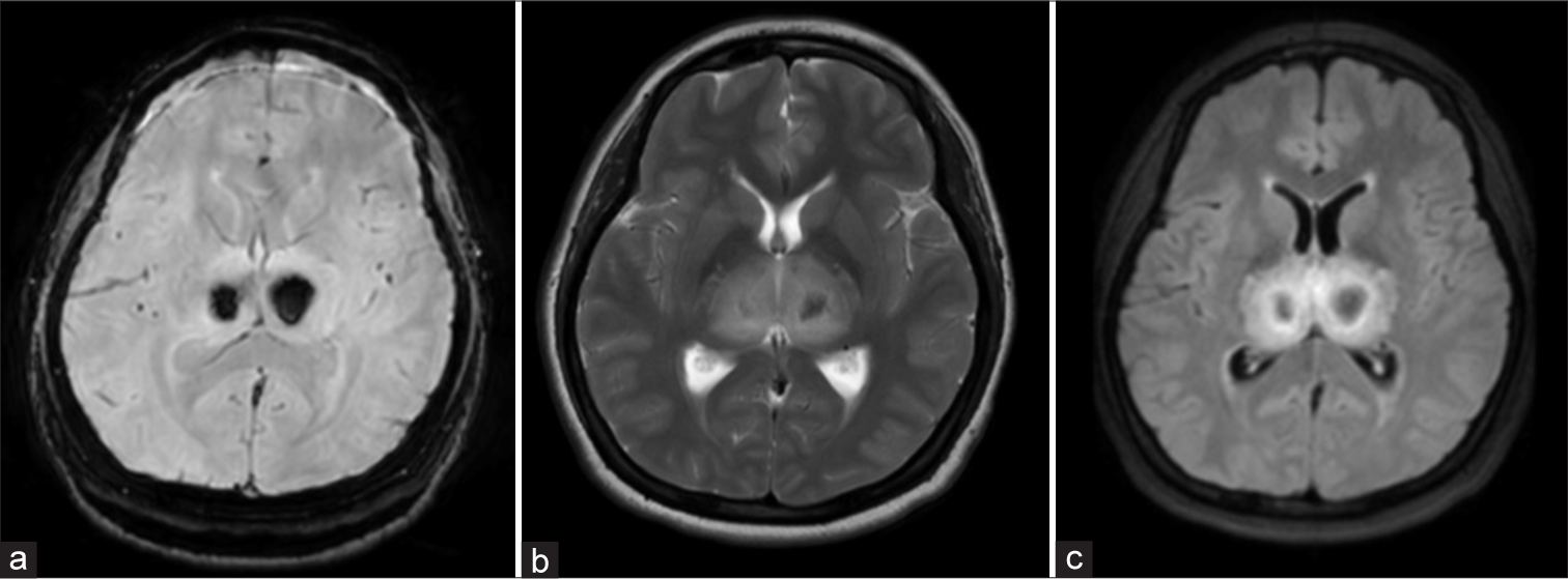 Cracking the nut open: The double-doughnut sign in flavivirus encephalitis