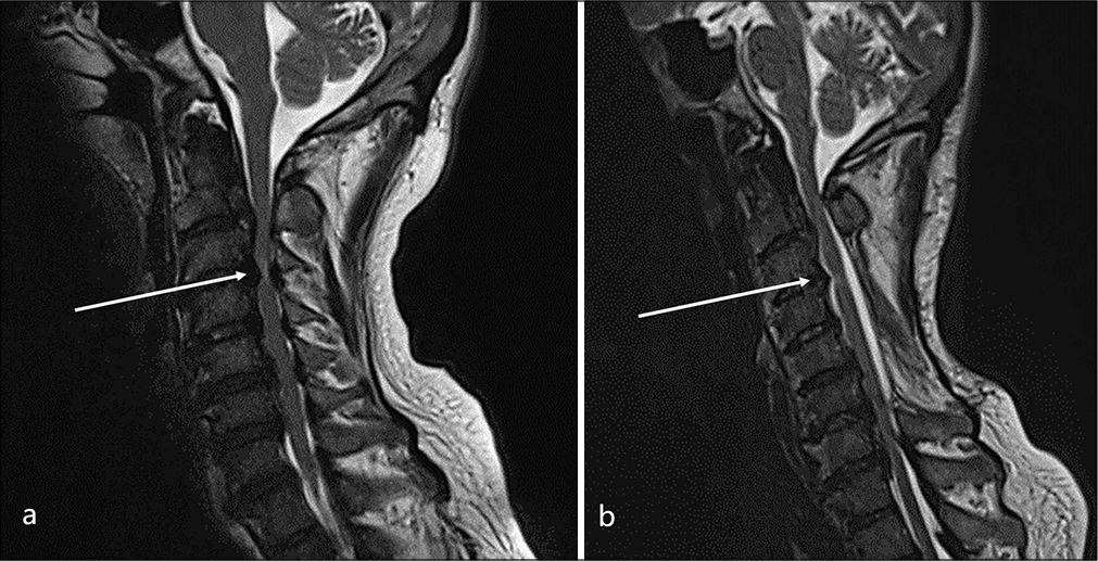 Endemic fluorosis and its impact on cases of cervico-dorsal ossification of the posterior longitudinal ligament: An overview