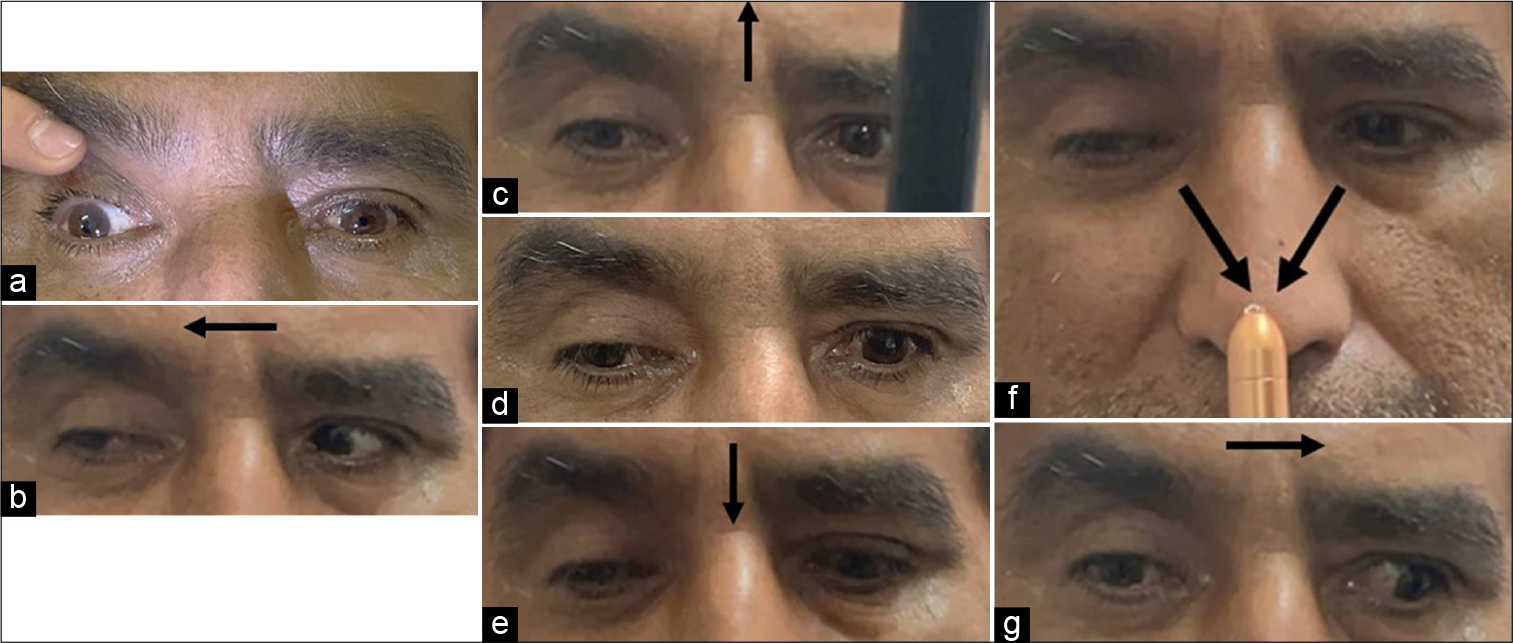 Claude syndrome unveiled in a case of thalamic-midbrain infarction