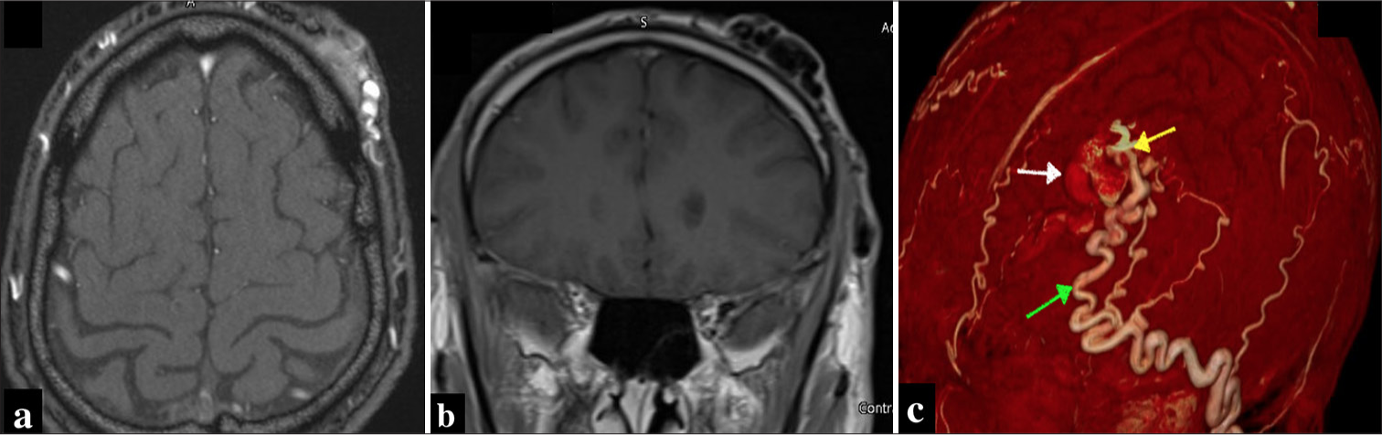 Post hair transplant scalp arteriovenous fistula: A case illustration with a collective review