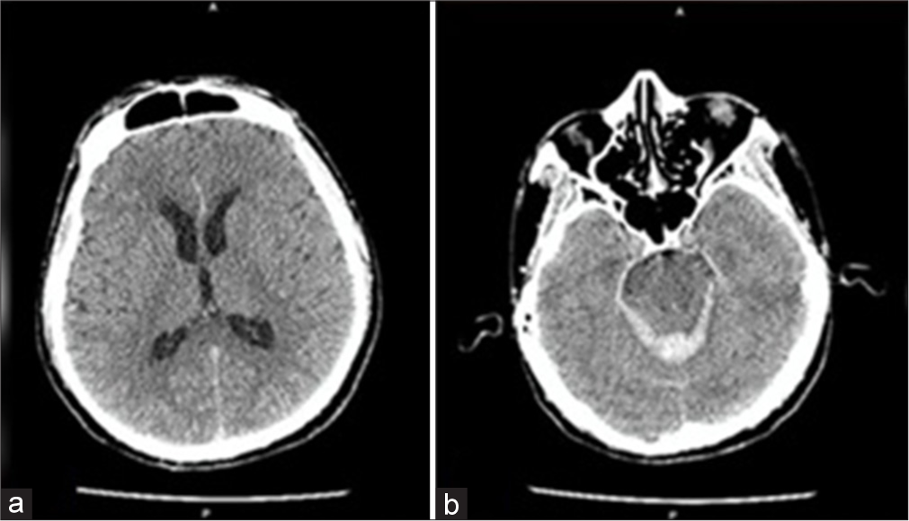 Vertebral artery dissecting aneurysm with subarachnoid hemorrhage treated by coil trapping: A case report