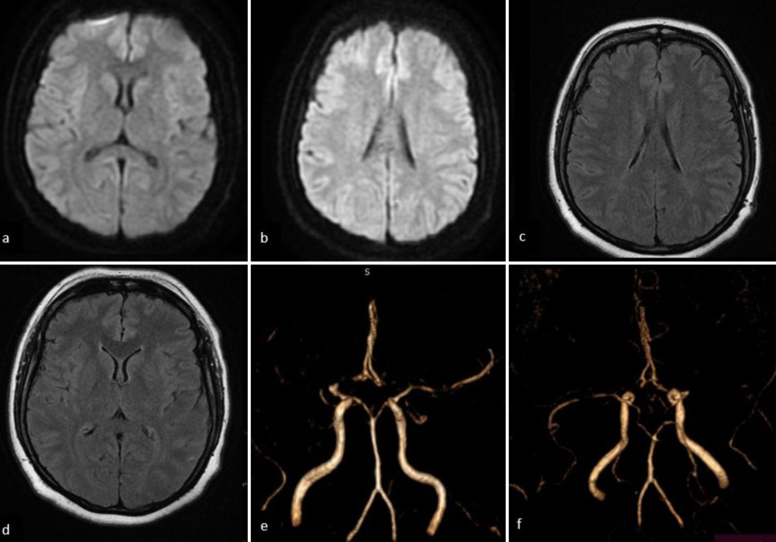 Recurrent hemodynamic ischemic strokes as the presenting feature of moyamoya disease