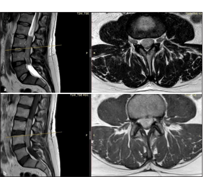 Primary intradural extramedullary Ewing sarcoma: Review of literature and update for a standard protocol