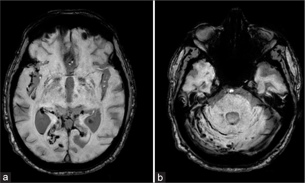 Dengue fever complicated by spontaneous intracranial and intraspinal hemorrhage: A case report