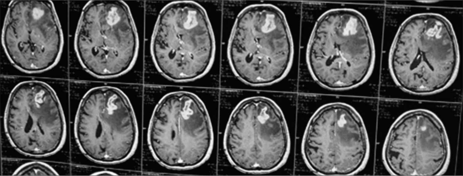 Primary central nervous system Hodgkin’s lymphoma – A case report and review of literature