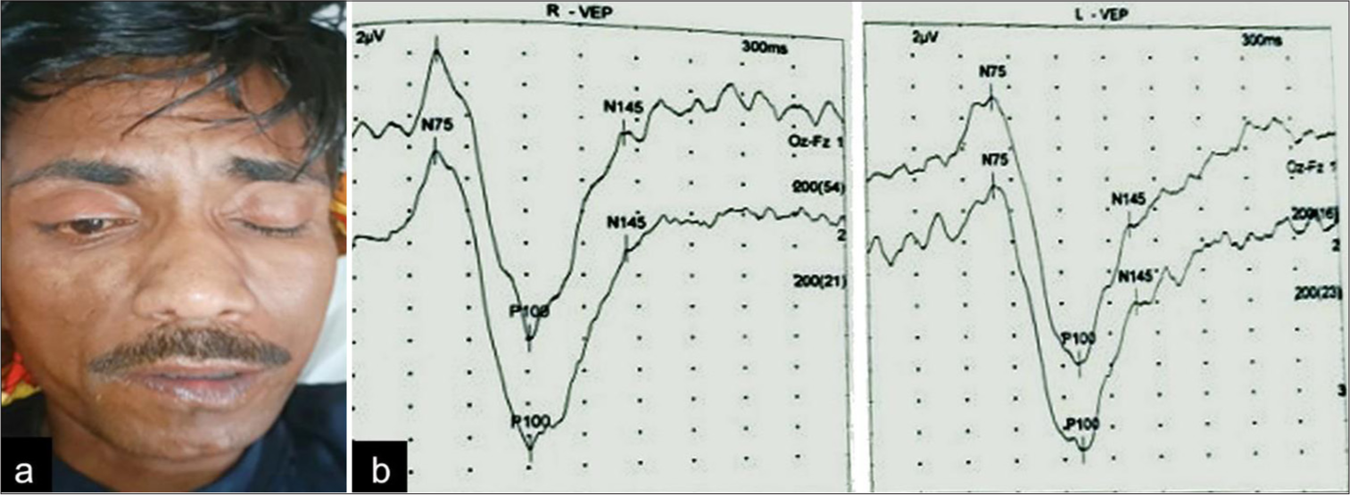 Myelin oligodendrocyte glycoprotein associated disease presenting as rhombencephalitis with horizontal gaze palsy