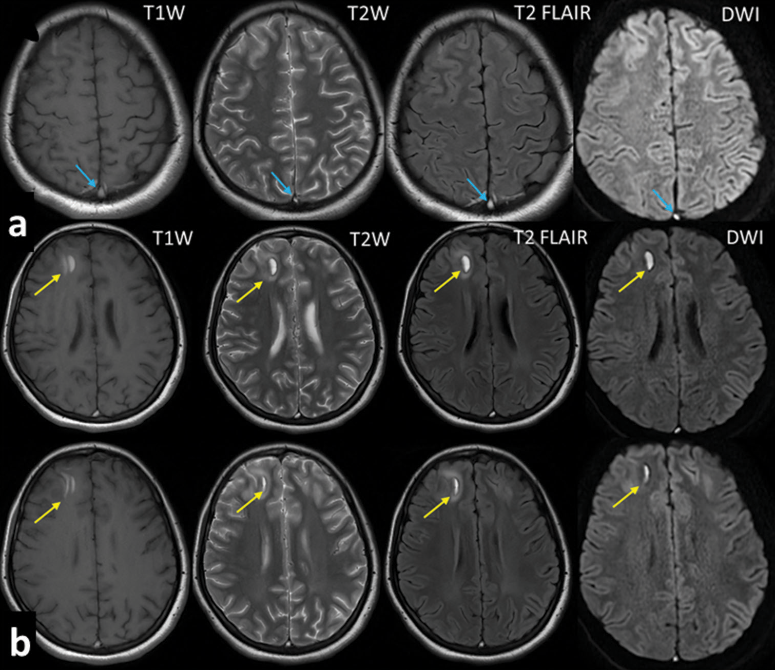 Crescent-shaped intracranial hemorrhage in cerebral venous sinus thrombosis: A case report and review of literature