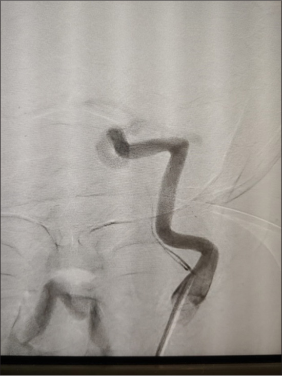 Origin of ascending pharyngeal artery from cervical internal carotid artery: A case report of rare anatomical variation