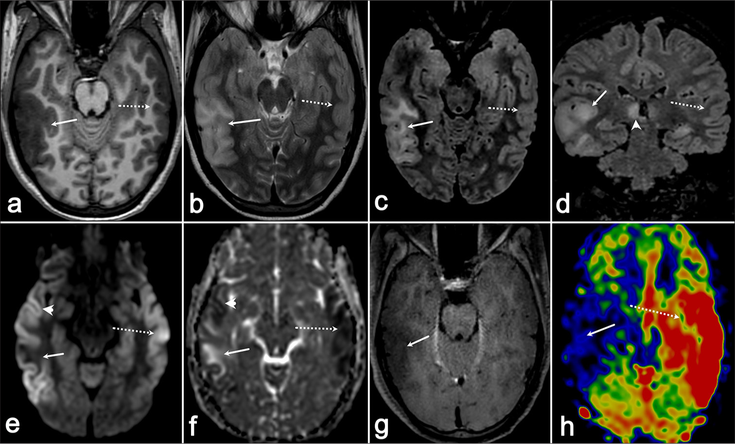 Fulminant anti-N-methyl-D-aspartate receptor autoimmune encephalitis presenting as extra-limbic cortical encephalitis