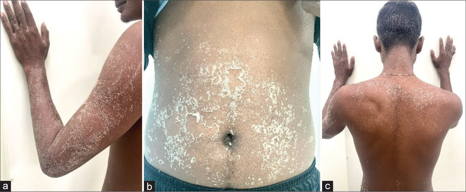 Rash decisions: A case report of Risperidone and exanthematous eruptions