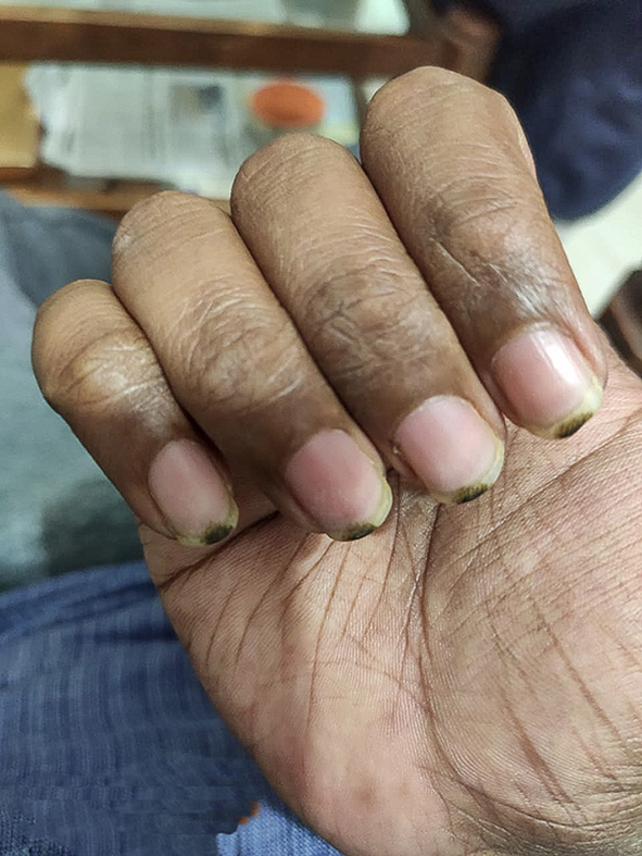 Emergence of nail hyperpigmentation possibly linked to fluoxetine: A case report