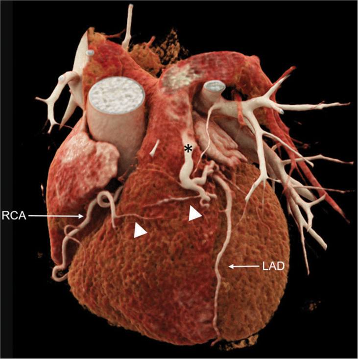 Vieussens’ arterial ring to main pulmonary artery fistula in patient with chest pain