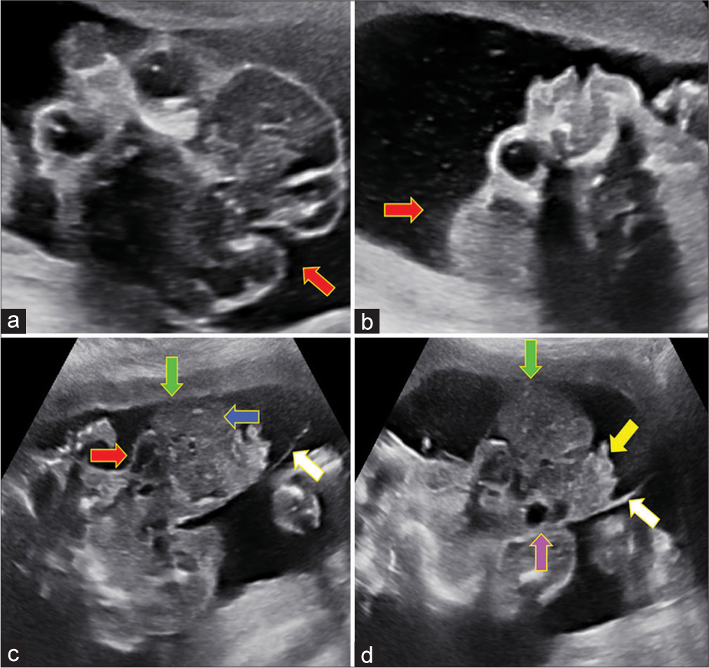 Decoding the dilemma of antenatal ventral body wall defects: A case report and literature review