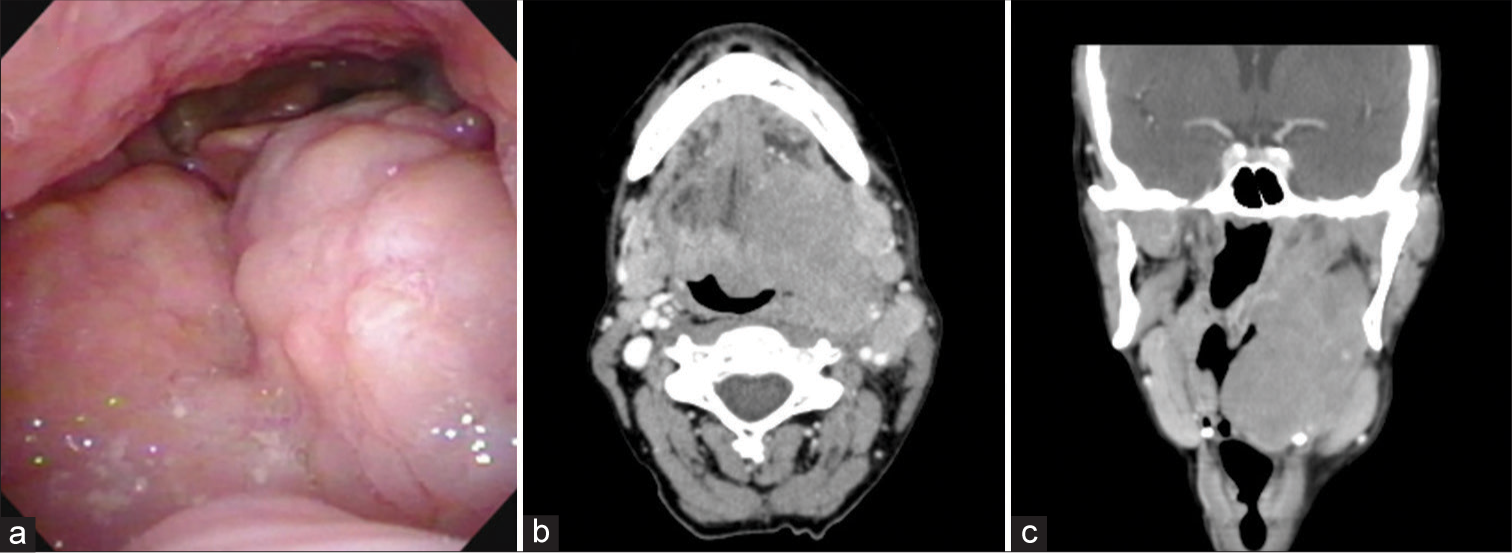 Imaging of extranodal lymphomas in the head and neck: A case series and review of the literature