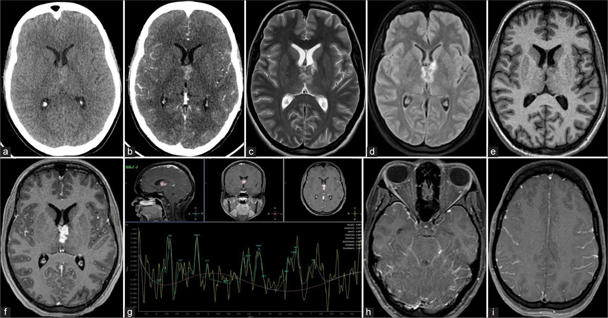 Two rare central nervous system manifestations of a common disease