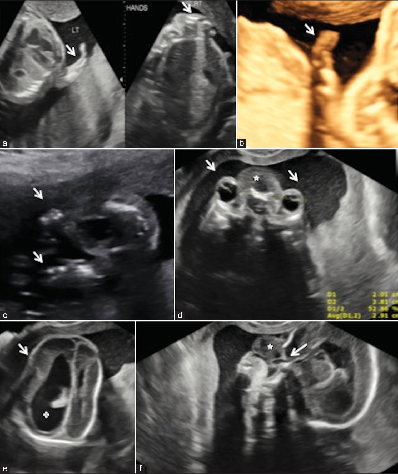 Multimodality approach in tetraphocomelia – An uncommonly seen red flag in anomaly scan