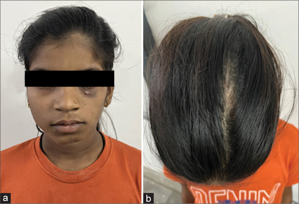 Unilateral facial asymmetry: Do not forget to look at the subcutaneous tissue