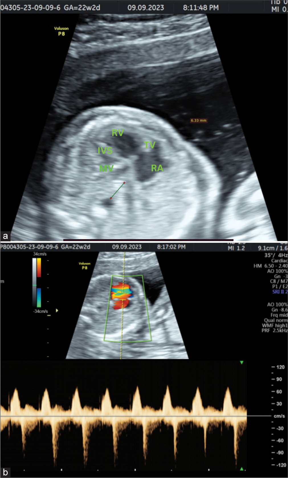 Complex fetal cardiac anomalies: Transposition, anomalous venous connection, and atresias